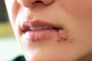 Các tổn thương mụn nước hoặc mụn rộp nhỏ có thể là biểu hiện nhiễm Herpes 